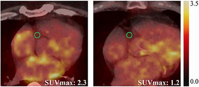 Association of Serum Biomarkers and Cardiac Inflammation in Patients With Atrial Fibrillation: Identification by Positron Emission Tomography